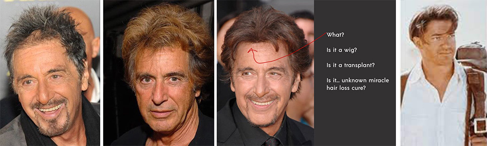 Al Pacino Hair Transplant