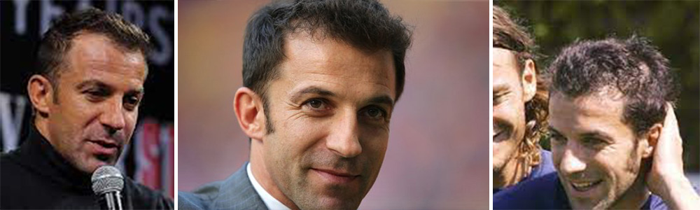 Alessandro Del Piero Hair Transplant