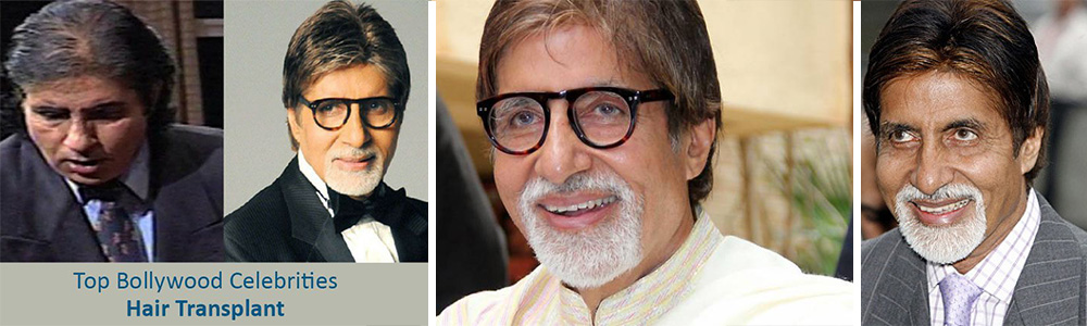Amitabh Bachchan Hair Transplant
