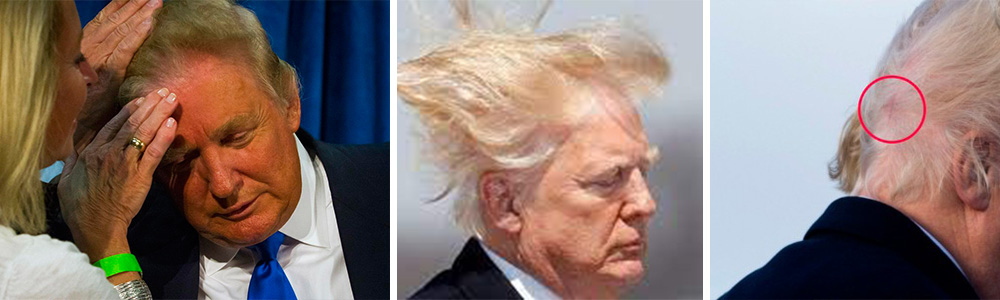Donald Trump Hair Transplant