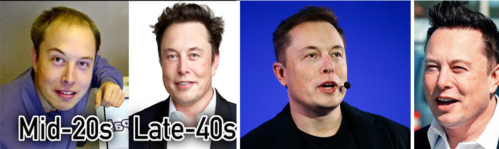 Elon Musk Hair Transplant