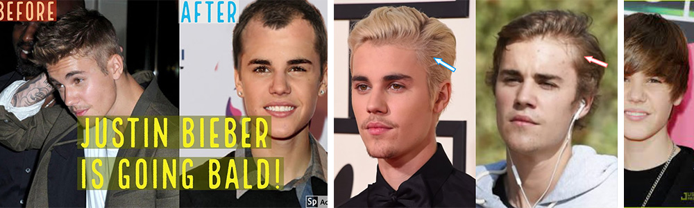 Justin Bieber Hair Transplant