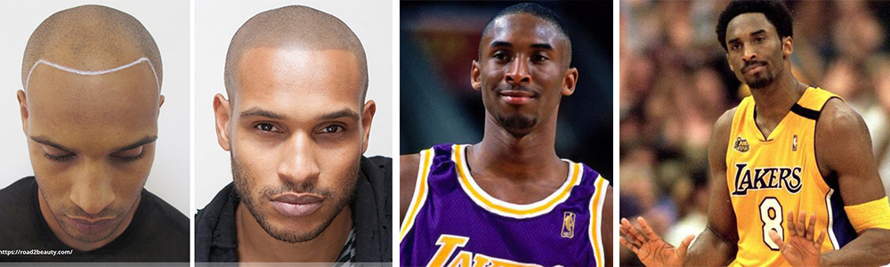 Kobe Bryant Hair Transplant