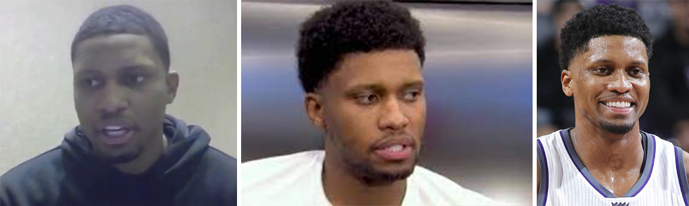 Rudy Gay Hair Transplant