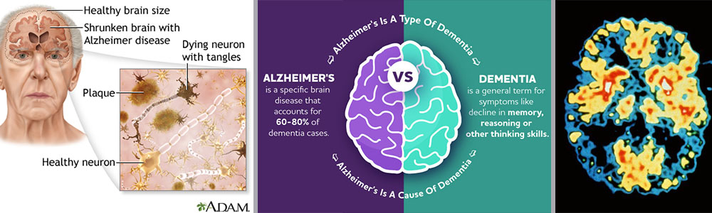 Alzheimer's or dementia