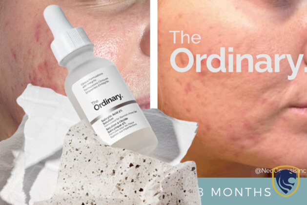 The Ordinary Salicylic Acid 2%: Superhero for Zits or Just So-So?